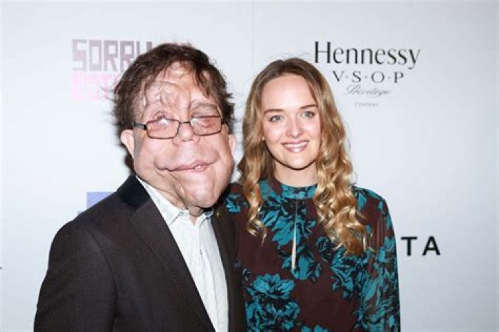 Discovering Adam Pearson's Height: The Man Behind the Screen
